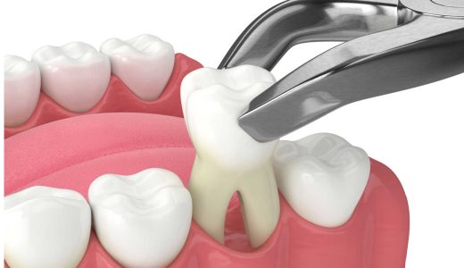 親知らず抜歯の実態｜経験者が語る痛み・腫れ・ケア方法