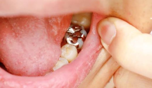 銀歯が原因！？隠れた金属アレルギーの正体とその対策