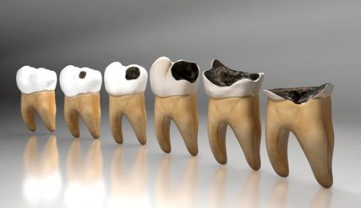 C1からC4まで完全解説！虫歯の進行度別治療ガイド